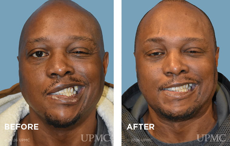Right facial nerve exploration and repair, 5-7 nerve transfer for flaccid facial paralysis due to penetrating facial injury
